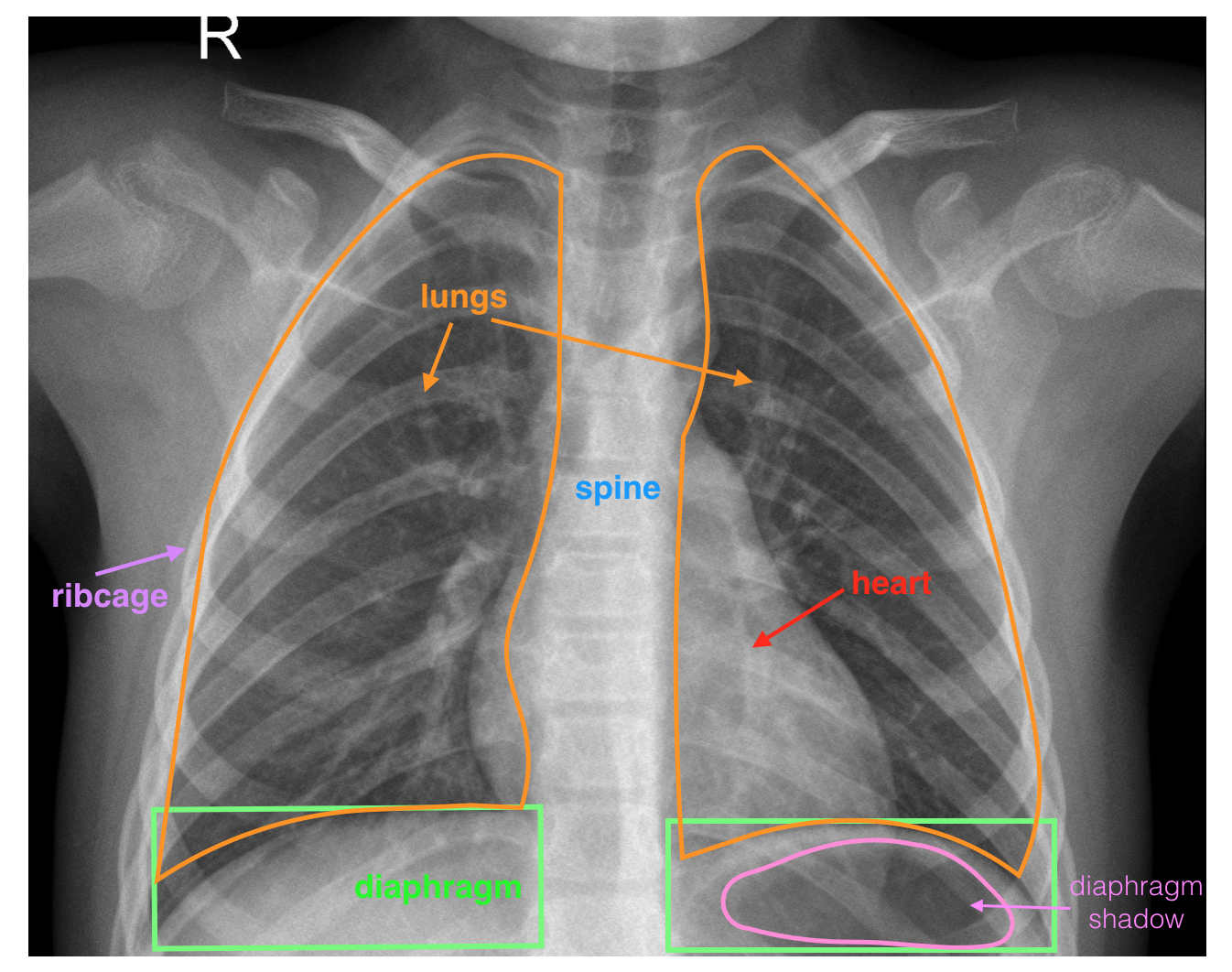 healthy annotated-chest-xray example