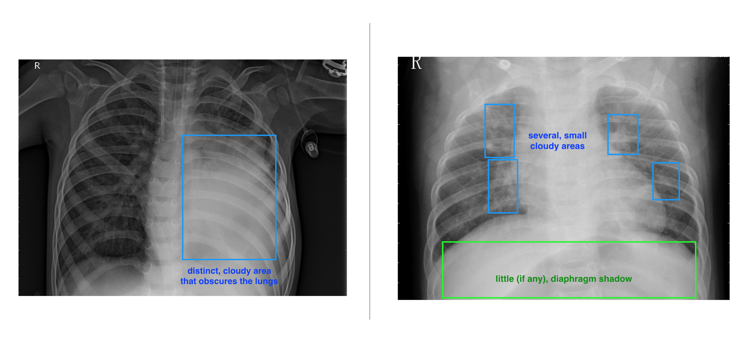 pneumonia xray examples