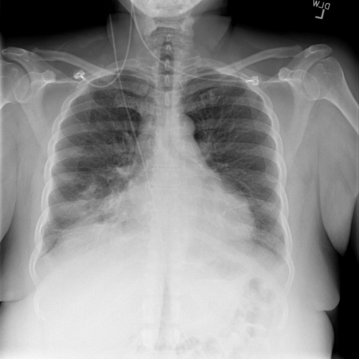 cxr2363